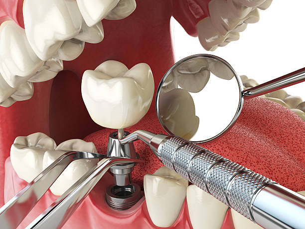 Best Emergency Tooth Extraction in Ansted, WV